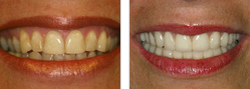 dos bocas. un antes y un después tras un tratamiento estético dental